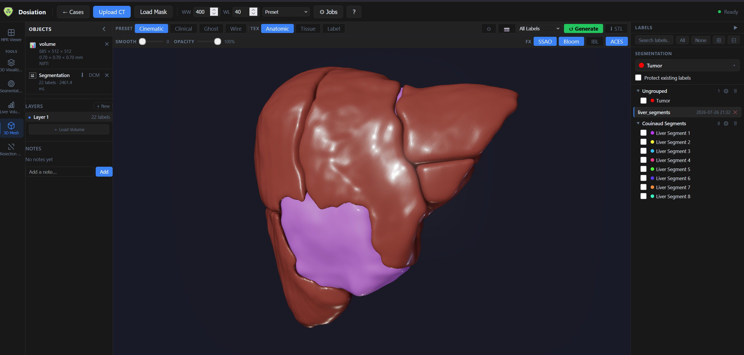 3D mesh viewer isolating the tumor and a single liver segment from the full Couinaud segmentation