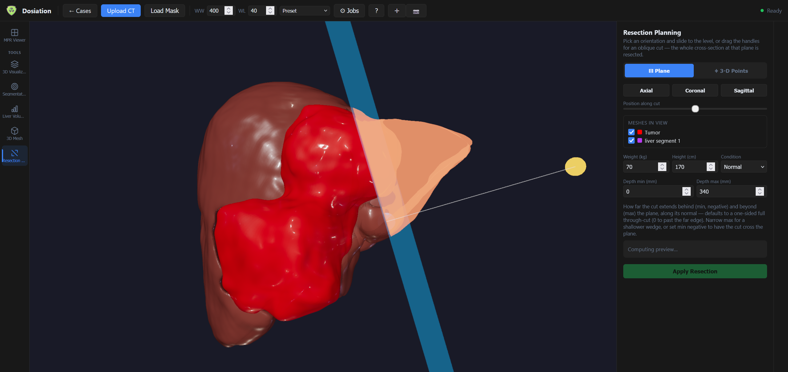 Resection planning tool with an oblique cut plane through the liver, tumor and one Couinaud segment highlighted