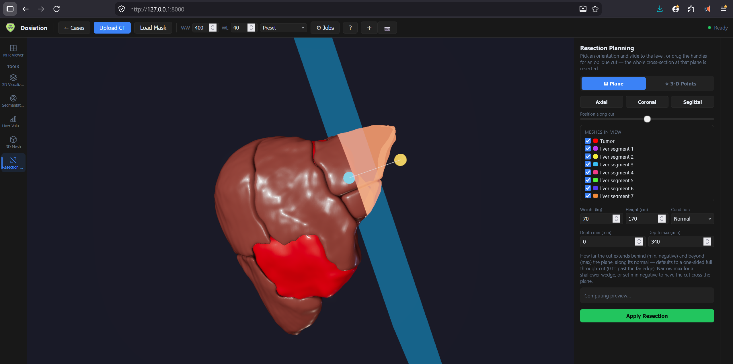 Resection planning tool — 3D liver mesh with tumor, 8 Couinaud segments, and a cut plane