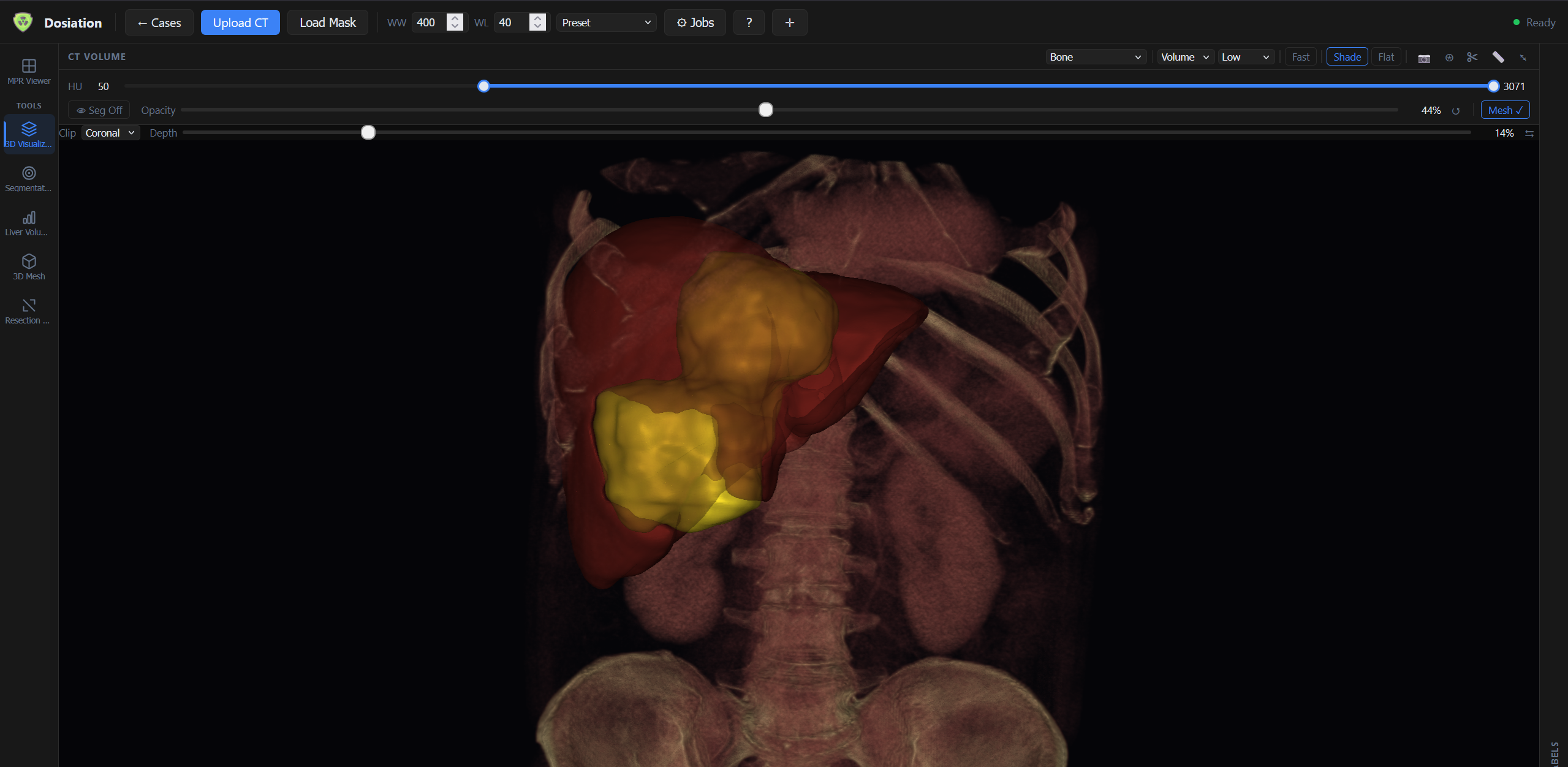 Volumetric CT clip render of tumor and liver