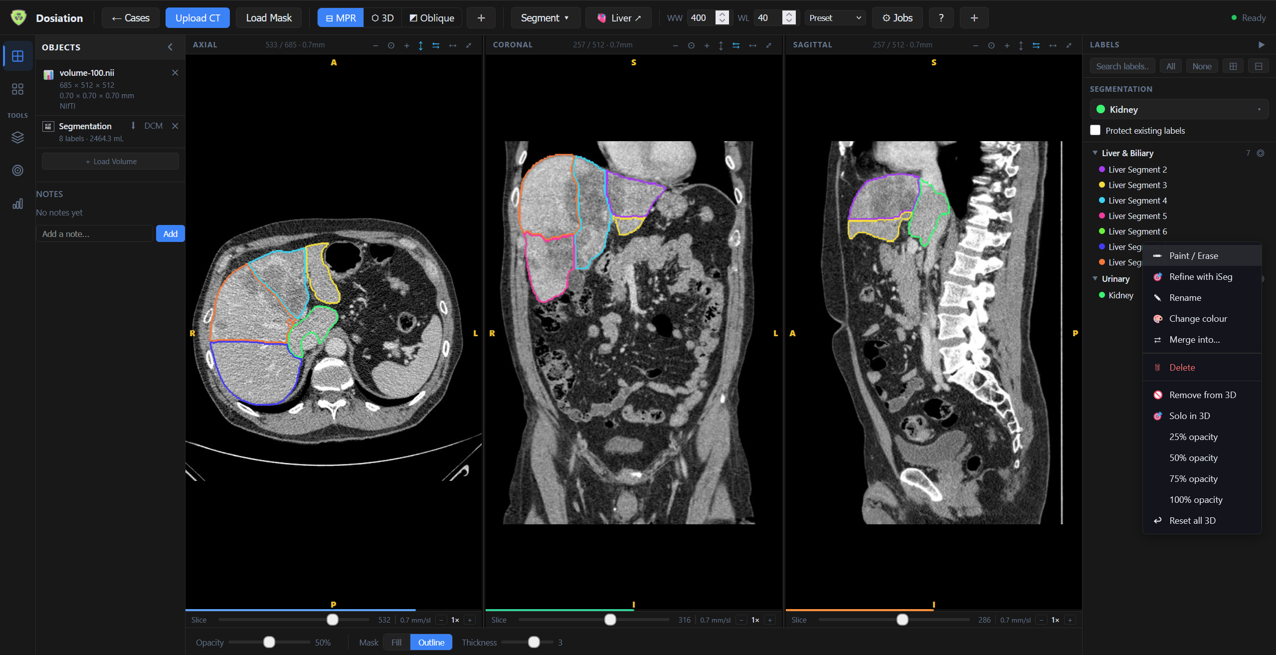 Liver segment contouring in outline mode with iSeg refinement context menu