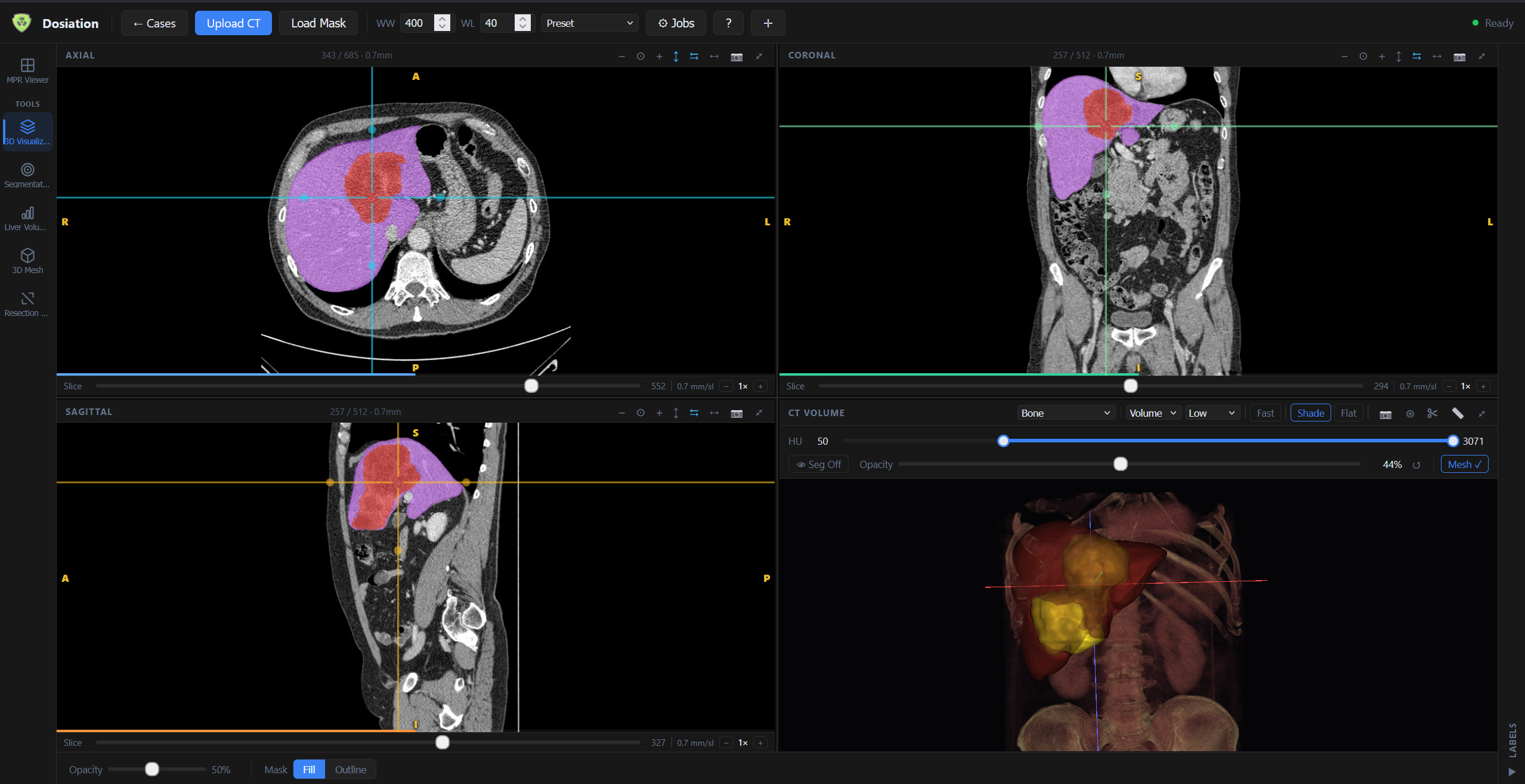 Full liver workspace — axial, coronal, sagittal MPR and synchronized 3D volume render with tumor and segment 1 highlighted