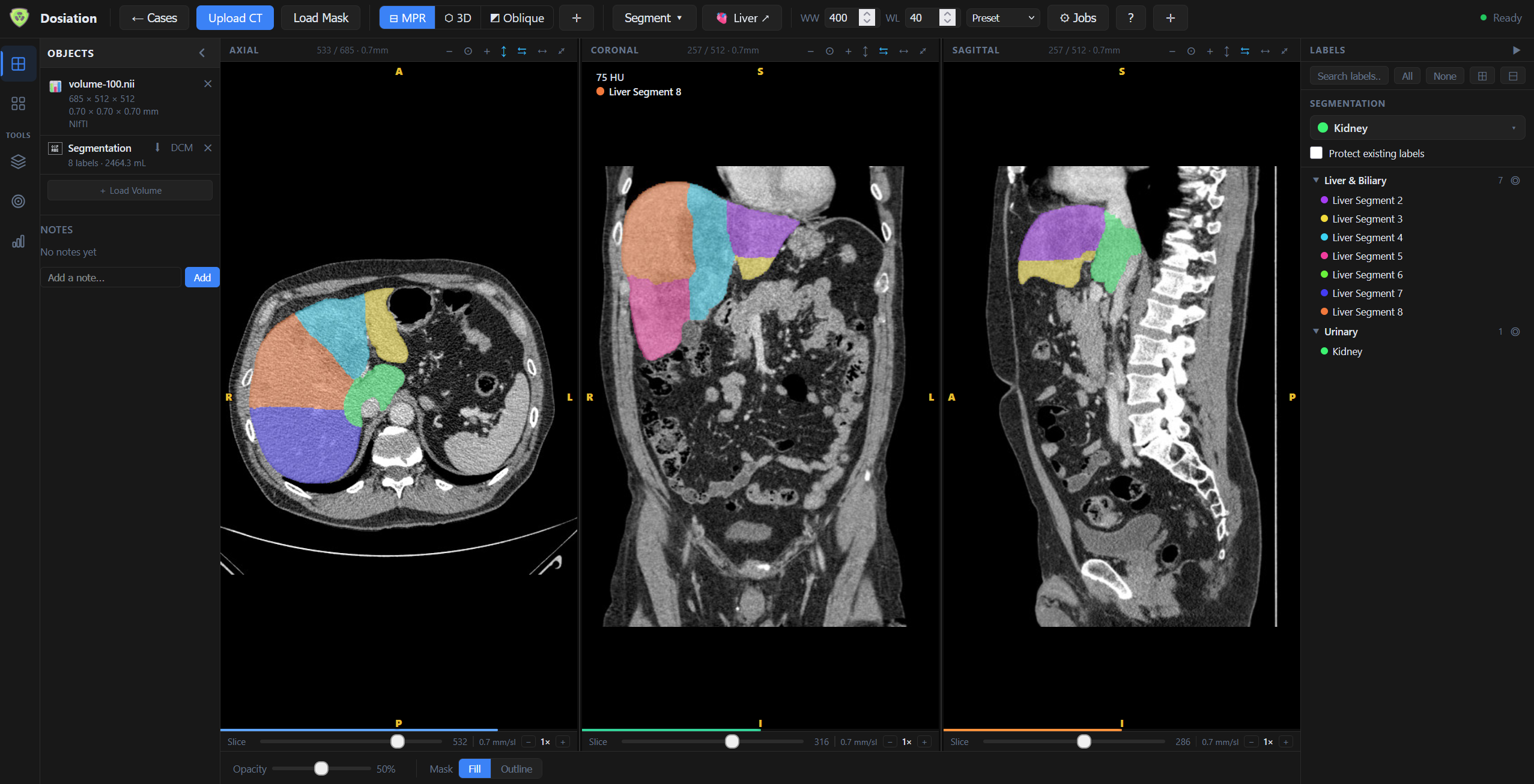Liver segment segmentation — axial, coronal, sagittal fill view
